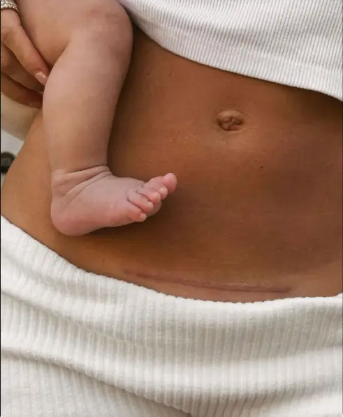 Postpartum mother holding baby with healed cesarean scar after VBAC