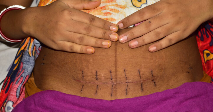 Postpartum mother showing a healing C-section incision across her lower abdomen